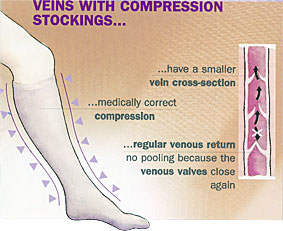 Veins with compression stockings
